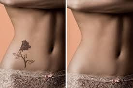 laser tattoo removal 4