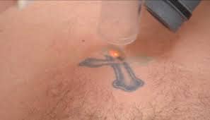 laser tattoo removal 5